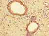 Immunohistochemistry of paraffin-embedded human prostate cancer using CSB-PA06879A0Rb at dilution of 1:100