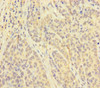 Immunohistochemistry of paraffin-embedded human ovarian cancer using CSB-PA06919A0Rb at dilution of 1:100