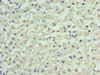 Immunohistochemistry of paraffin-embedded human liver cancer using CSB-PA07057A0Rb at dilution of 1:100