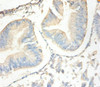 Immunohistochemistry of paraffin-embedded human endometrial cancer using CSB-PA07154A0Rb at dilution of 1:100