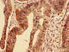 Immunocytochemistry analysis of human colon cancer using CSB-PA07219A0Rb at dilution of 1:100