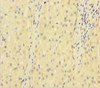 Immunohistochemistry of paraffin-embedded human liver cancer using CSB-PA07279A0Rb at dilution of 1:100