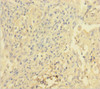 Immunohistochemistry of paraffin-embedded human lung cancer using CSB-PA07279A0Rb at dilution of 1:100