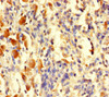 Immunohistochemistry of paraffin-embedded human melanoma using CSB-PA07294A0Rb at dilution of 1:100