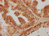 IHC image of CSB-PA07309A0Rb diluted at 1:600 and staining in paraffin-embedded human prostate cancer performed on a Leica BondTM system. After dewaxing and hydration, antigen retrieval was mediated by high pressure in a citrate buffer (pH 6.0) . Section was blocked with 10% normal goat serum 30min at RT. Then primary antibody (1% BSA) was incubated at 4°C overnight. The primary is detected by a biotinylated secondary antibody and visualized using an HRP conjugated SP system.