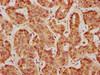 IHC image of CSB-PA07309A0Rb diluted at 1:600 and staining in paraffin-embedded human liver cancer performed on a Leica BondTM system. After dewaxing and hydration, antigen retrieval was mediated by high pressure in a citrate buffer (pH 6.0) . Section was blocked with 10% normal goat serum 30min at RT. Then primary antibody (1% BSA) was incubated at 4°C overnight. The primary is detected by a biotinylated secondary antibody and visualized using an HRP conjugated SP system.