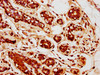 IHC image of CSB-PA07315A0Rb diluted at 1:400 and staining in paraffin-embedded human breast cancer performed on a Leica BondTM system. After dewaxing and hydration, antigen retrieval was mediated by high pressure in a citrate buffer (pH 6.0) . Section was blocked with 10% normal goat serum 30min at RT. Then primary antibody (1% BSA) was incubated at 4°C overnight. The primary is detected by a biotinylated secondary antibody and visualized using an HRP conjugated SP system.