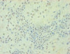 Immunohistochemistry of paraffin-embedded human breast cancer using CSB-PA07319A0Rb at dilution of 1:100