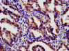 IHC image of CSB-PA08129A0Rb diluted at 1:180 and staining in paraffin-embedded human lung cancer performed on a Leica BondTM system. After dewaxing and hydration, antigen retrieval was mediated by high pressure in a citrate buffer (pH 6.0) . Section was blocked with 10% normal goat serum 30min at RT. Then primary antibody (1% BSA) was incubated at 4°C overnight. The primary is detected by a biotinylated secondary antibody and visualized using an HRP conjugated SP system.