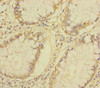 Immunohistochemistry of paraffin-embedded human colon cancer using CSB-PA08919A0Rb at dilution of 1:100