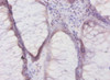 Immunohistochemistry of paraffin-embedded human colon cancer using CSB-PA09854A0Rb at dilution of 1:50