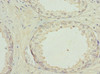 Immunohistochemistry of paraffin-embedded human prostate cancer using CSB-PA10065A0Rb at dilution of 1:100