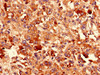 Immunohistochemistry analysis of human melanoma using CSB-PA10715A0Rb at dilution of 1:100