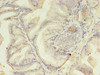 Immunohistochemistry of paraffin-embedded human prostate cancer using CSB-PA11039A0Rb at dilution of 1:100