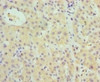 Immunohistochemistry of paraffin-embedded human liver cancer using CSB-PA11049A0Rb at dilution of 1:100