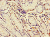 Immunohistochemistry of paraffin-embedded human gastric cancer using CSB-PA11319A0Rb at dilution of 1:100