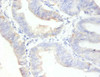 Immunohistochemistry of paraffin-embedded human endometrial cancer using CSB-PA11617A0Rb at dilution of 1:100