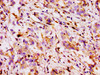 Immunohistochemistry of paraffin-embedded human liver cancer using CSB-PA11737A0Rb at dilution of 1:100