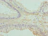 Immunohistochemistry of paraffin-embedded human prostate cancer using CSB-PA12799A0Rb at dilution of 1:100