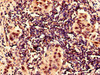 Immunocytochemistry analysis of human bladder cancer using CSB-PA12807A0Rb at dilution of 1:100