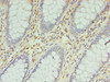 Immunohistochemistry of paraffin-embedded human colon cancer using CSB-CSB-PA13169A0Rb at dilution of 1:100