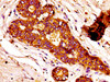 IHC image of CSB-PA13179A0Rb diluted at 1:100 and staining in paraffin-embedded human breast cancer performed on a Leica BondTM system. After dewaxing and hydration, antigen retrieval was mediated by high pressure in a citrate buffer (pH 6.0) . Section was blocked with 10% normal goat serum 30min at RT. Then primary antibody (1% BSA) was incubated at 4°C overnight. The primary is detected by a biotinylated secondary antibody and visualized using an HRP conjugated SP system.