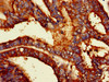 Immunohistochemistry of paraffin-embedded human endometrial cancer using CSB-PA13447A0Rb at dilution of 1:100