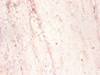 Immunohistochemistry of paraffin-embedded human colon cancer using CSB-PA13549A0Rb at diluton of 1:50