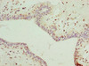 Immunohistochemistry of paraffin-embedded human breast cancer using CSB-PA13569A0Rb at dilution of 1:100