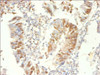 Immunohistochemistry of paraffin-embedded human colon cancer using CSB-PA13674A0Rb at dilution of 1:100