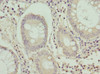 Immunohistochemistry of paraffin-embedded human colon cancer using CSB-PA13969A0Rb at dilution of 1:100
