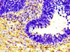 IHC image of CSB-PA14609A0Rb diluted at 1:600 and staining in paraffin-embedded human ovarian cancer performed on a Leica BondTM system. After dewaxing and hydration, antigen retrieval was mediated by high pressure in a citrate buffer (pH 6.0) . Section was blocked with 10% normal goat serum 30min at RT. Then primary antibody (1% BSA) was incubated at 4°C overnight. The primary is detected by a biotinylated secondary antibody and visualized using an HRP conjugated SP system.