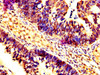 IHC image of CSB-PA15479A0Rb diluted at 1:200 and staining in paraffin-embedded human ovarian cancer performed on a Leica BondTM system. After dewaxing and hydration, antigen retrieval was mediated by high pressure in a citrate buffer (pH 6.0) . Section was blocked with 10% normal goat serum 30min at RT. Then primary antibody (1% BSA) was incubated at 4°C overnight. The primary is detected by a biotinylated secondary antibody and visualized using an HRP conjugated SP system.