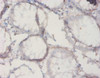 Immunohistochemistry of paraffin-embedded human colon cancer using CSB-PA16769A0Rb at dilution of 1:20