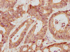 IHC image of CSB-PA17509A0Rb diluted at 1:709 and staining in paraffin-embedded human colon cancer performed on a Leica BondTM system. After dewaxing and hydration, antigen retrieval was mediated by high pressure in a citrate buffer (pH 6.0) . Section was blocked with 10% normal goat serum 30min at RT. Then primary antibody (1% BSA) was incubated at 4°C overnight. The primary is detected by a biotinylated secondary antibody and visualized using an HRP conjugated SP system.