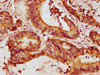 IHC image of CSB-PA17739A0Rb diluted at 1:200 and staining in paraffin-embedded human colon cancer performed on a Leica BondTM system. After dewaxing and hydration, antigen retrieval was mediated by high pressure in a citrate buffer (pH 6.0) . Section was blocked with 10% normal goat serum 30min at RT. Then primary antibody (1% BSA) was incubated at 4°C overnight. The primary is detected by a biotinylated secondary antibody and visualized using an HRP conjugated SP system.