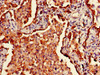 Immunohistochemistry of paraffin-embedded human lung cancer using CSB-PA17949D0Rb at dilution of 1:100
