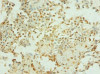 Immunohistochemistry of paraffin-embedded human breast cancer using CSB-PA18049A0Rb at dilution of 1: 100