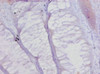 Immunohistochemistry of paraffin-embedded human colon cancer using CSB-PA18099A0Rb at dilution of 1:20