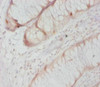 Immunohistochemistry of paraffin-embedded human colon cancer using CSB-PA18109A0Rb at dilution of 1:20