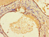 Immunohistochemistry of paraffin-embedded human prostate cancer using CSB-PA338892LA01HU at dilution of 1:100