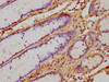 IHC image of CSB-PA365592HA01HU diluted at 1:500 and staining in paraffin-embedded human gastric cancer performed on a Leica BondTM system. After dewaxing and hydration, antigen retrieval was mediated by high pressure in a citrate buffer (pH 6.0) . Section was blocked with 10% normal goat serum 30min at RT. Then primary antibody (1% BSA) was incubated at 4°C overnight. The primary is detected by a biotinylated secondary antibody and visualized using an HRP conjugated SP system.