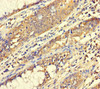 Immunohistochemistry of paraffin-embedded human colon cancer using CSB-PA610370LA01HU at dilution of 1:100