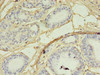 Immunohistochemistry of paraffin-embedded human breast cancer using CSB-PA613392LA01HU at dilution of 1:100