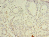Immunohistochemistry of paraffin-embedded human breast cancer using CSB-PA613521LA01HU at dilution of 1:100
