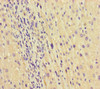Immunohistochemistry of paraffin-embedded human liver cancer using CSB-PA617994LA01HU at dilution of 1:100
