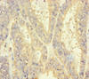 Immunohistochemistry of paraffin-embedded human endometrial cancer using CSB-PA621784LA01HU at dilution of 1:100