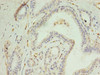 Immunohistochemistry of paraffin-embedded human breast cancer using CSB-PA623930LA01HU at dilution of 1:100