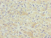 Immunohistochemistry of paraffin-embedded human liver cancer using CSB-PA624192LA01HU at dilution of 1:100