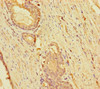 Immunohistochemistry of paraffin-embedded human prostate cancer using CSB-PA652063LA01HU at dilution of 1:100